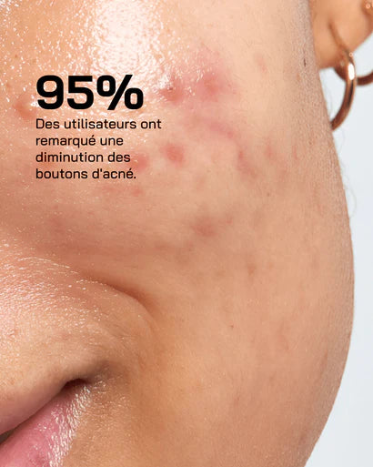 Touché - Sérum Anti Acné, 30ml